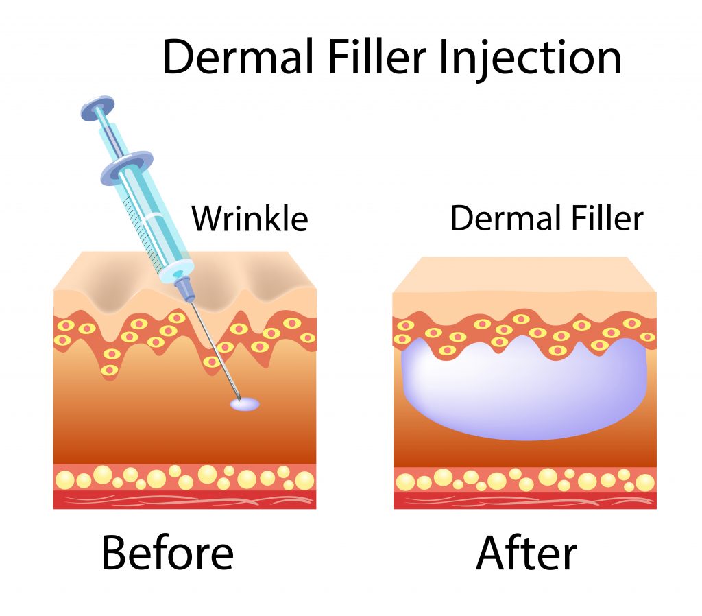 Can Getting Dermal Fillers In My 20s Help Fight Signs Of Aging Luxe