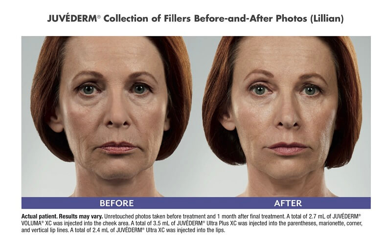 Fillers - Luxe Medical Aesthetics