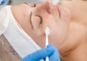 chemical peel procedure