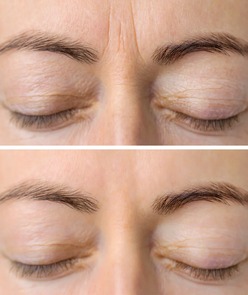 A close-up of a forehead highlighting the dramatic reduction of wrinkles before and after Botox treatment.