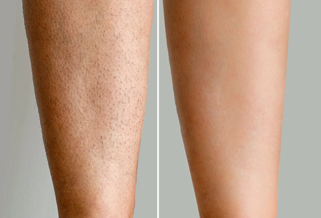 Before and after laser hair removal on a leg, showing smooth, hair-free skin.