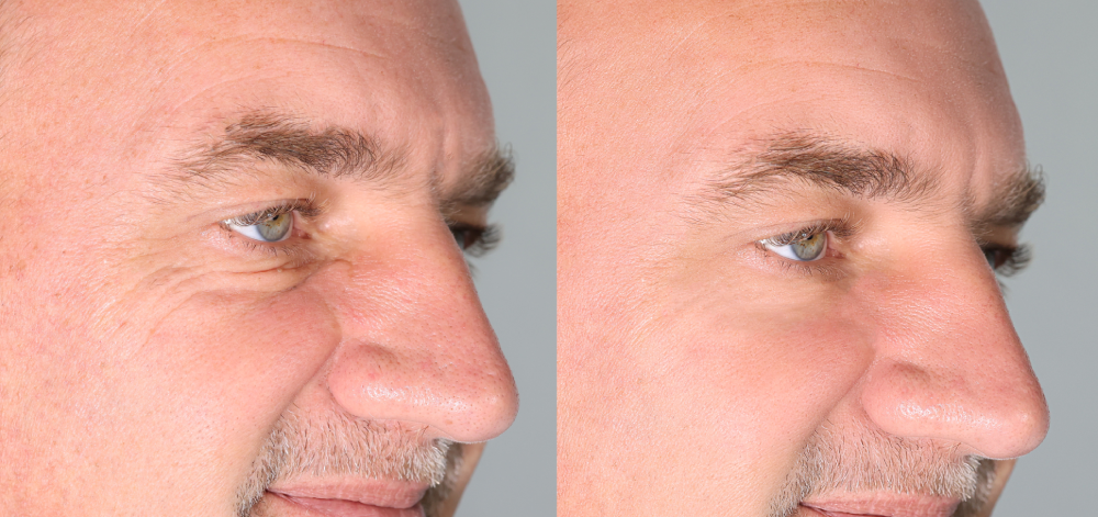 Botox treatment before and after comparison on a man's face.
