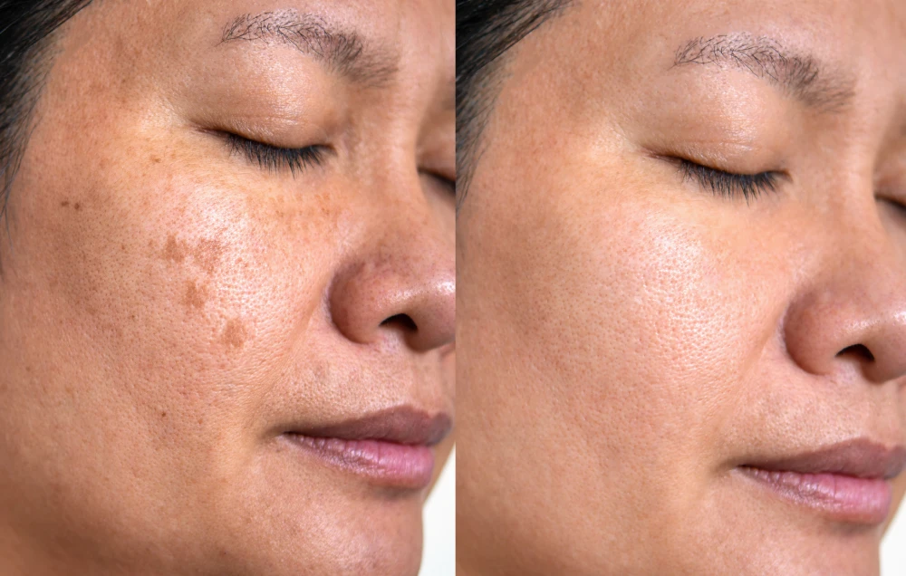 Close-up before and after showing skin improvements with chemical peels.