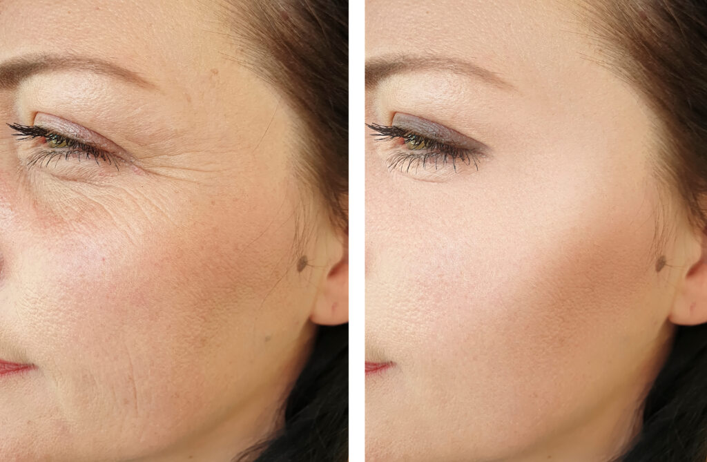 Before and after results of skin rejuvenation with Rejuran injections.