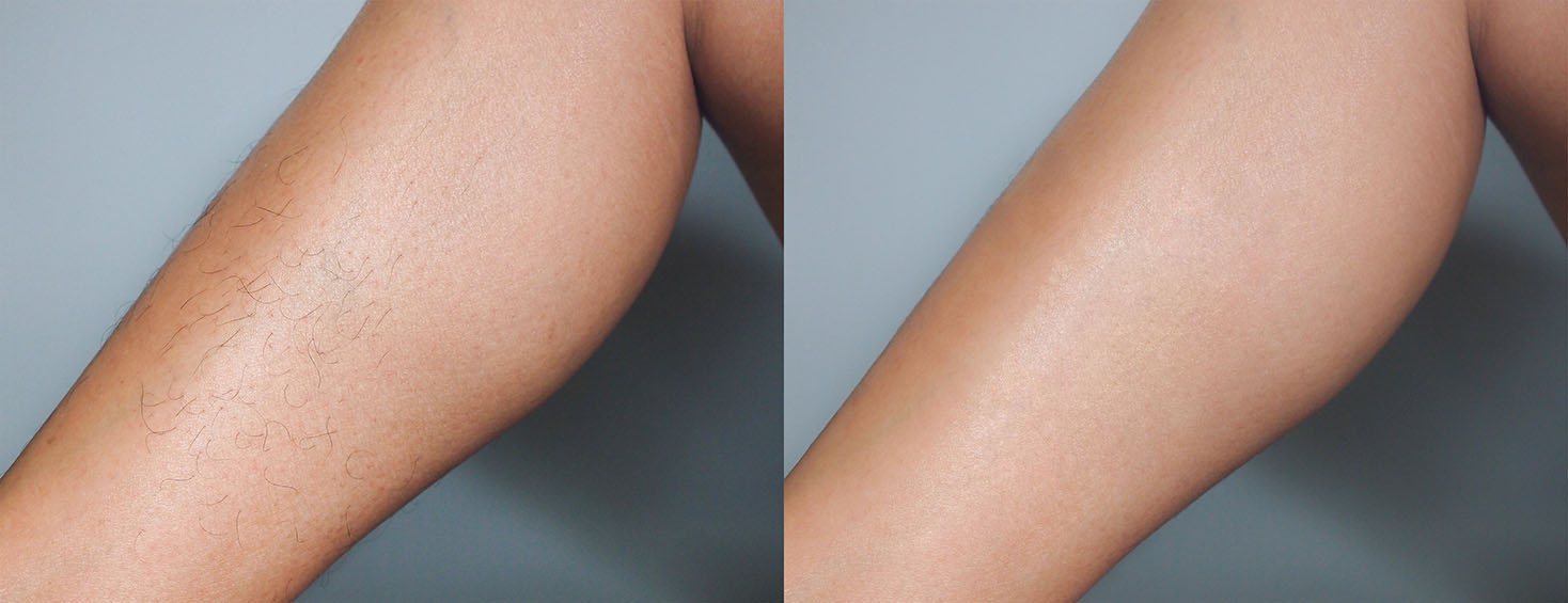Before and after comparison of arm hair showing reduced hair growth following laser hair removal treatments.