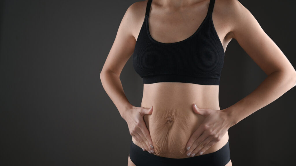 Person places both hands on the lower abdomen showing visible loose skin while wearing a black sports bra.