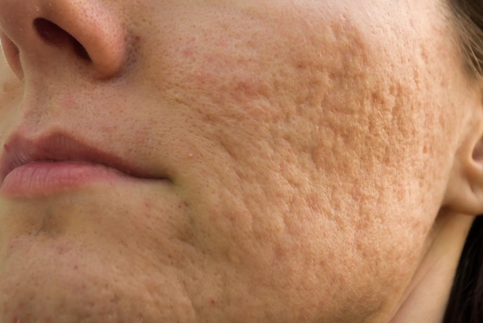 Close-up of a cheek showing visible uneven texture, enlarged pores, and indented acne scars.